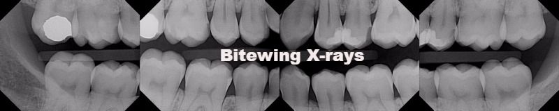 Bitewing X-rays, Alpha Dental Care St. Louis
